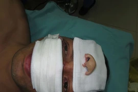 Ca nối mũi đứt rời thành công đầu tiên ở Việt Nam