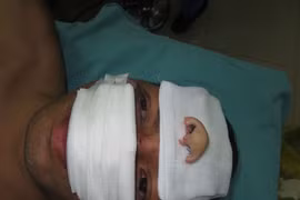 Ca nối mũi đứt rời thành công đầu tiên ở Việt Nam