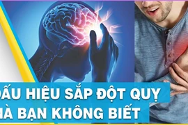 Dấu hiệu cảnh báo có thể sắp bị đột quỵ không phải ai cũng biết