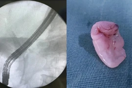 Đột ngột vàng da, vàng mắt... đi khám phát hiện sán lá gan trong bụng