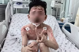 Sau 2 ngày ăn cua, bé trai 8 tuổi lở loét khắp người, nhiễm trùng nặng
