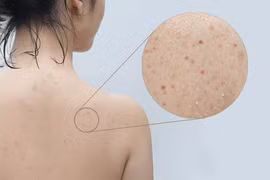 Đánh bay mụn lưng hiệu quả với 7 bước đơn giản