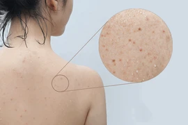 Đánh bay mụn lưng hiệu quả với 7 bước đơn giản