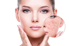 Cách chăm sóc và điều trị sẹo rỗ