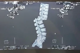 Ngã chấn thương cột sống khi trèo cây hái vải: Bác sĩ cảnh báo gì?