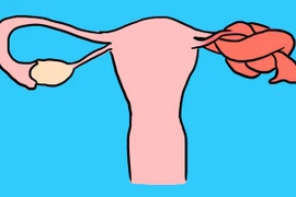 Xoắn buồng trứng nguy hiểm như thế nào?