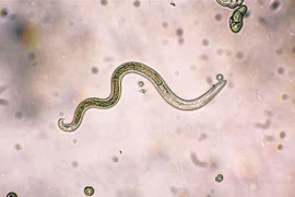 Mắc bệnh hiếm do không tẩy giun nhiều năm: Bác sĩ cảnh báo gì?