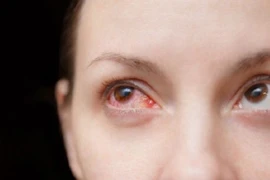 Nhóm thực phẩm người bị bệnh đau mắt đỏ nên tránh xa