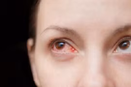 Nhóm thực phẩm người bị bệnh đau mắt đỏ nên tránh xa