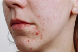 Chăm sóc da mụn cần tránh những thành phần nào?