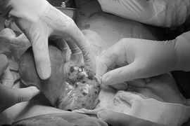 Phẫu thuật thành công cho bé gái 15 tuổi bị u buồng trứng xoắn