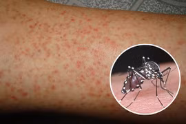 Số ca mắc sốt xuất huyết tại Hà Nội gia tăng so với những tuần trước