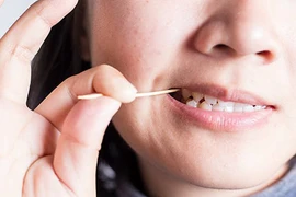 Quảng Ninh: Gắp chiếc tăm dài gần 7cm găm sâu vào dạ dày bệnh nhân