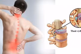 6 cách phòng tránh thoát vị đĩa đệm ai cũng nên biết 
