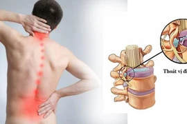 6 cách phòng tránh thoát vị đĩa đệm ai cũng nên biết 