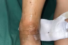 Bị rắn độc cắn, bé trai bị rối loạn đông máu, bàn chân tổn thương nặng