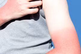 Học ngay 5 mẹo dưỡng da tay cháy nắng đơn giản tại nhà