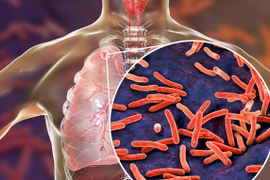  Ho ra 300 ml máu do di chứng lao phổi: Ai có nguy cơ mắc bệnh?