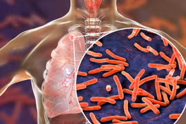  Ho ra 300 ml máu do di chứng lao phổi: Ai có nguy cơ mắc bệnh?