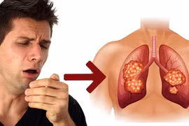 Ho kéo dài: Nguyên nhân và các lưu ý đừng chủ quan