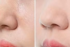 Cách trị sợi bã nhờn trên mũi hiệu quả tại nhà