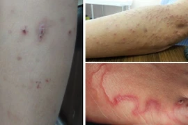 Lở loét khắp người 10 năm mới biết nhiễm giun đũa chó mèo