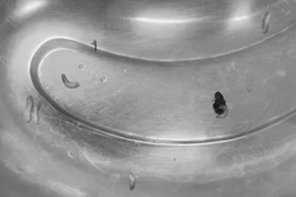 Hàng chục con giòi làm tổ trong tai người đàn ông 63 tuổi