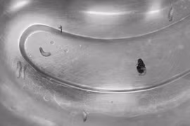 Hàng chục con giòi làm tổ trong tai người đàn ông 63 tuổi