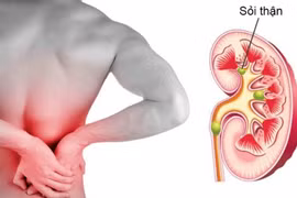 6 thói quen xấu thường ngày khiến thận chứa cả ‘túi sỏi'