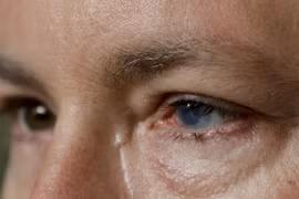 Cấy ghép tế bào gốc tự thân chữa mù lòa