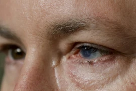 Cấy ghép tế bào gốc tự thân chữa mù lòa