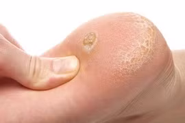 Loại bỏ các vết chai chân cứng đầu với mẹo cực đơn giản