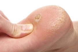 Loại bỏ các vết chai chân cứng đầu với mẹo cực đơn giản