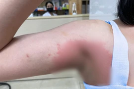 Chi hàng chục triệu làm trắng nách, người phụ nữ bị dị ứng bội nhiễm