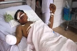 Vật lạ trên rẫy phát nổ lớn hai cha con suýt chết