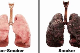 Nhiều bệnh nhân phải cấp cứu vì bệnh lý đường hô hấp do hút thuốc lá