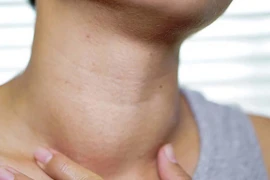 Suy tim, nhiễm khuẩn huyết vì bệnh Basedow