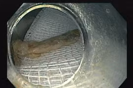 Gắp xương gà 2,5 cm cắm sâu vào thực quản: Cách xử đúng khi hóc xương