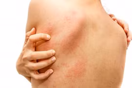 Thuê quần áo chụp ảnh sống ảo, cô gái bị phát ban khắp cơ thể