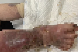 Suy tuyến thượng thận, nhiễm trùng bàn chân nặng vì lạm dụng thuốc giảm đau