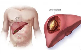 9 dấu hiệu ung thư gan giai đoạn đầu cần lưu ý