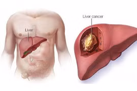 9 dấu hiệu ung thư gan giai đoạn đầu cần lưu ý