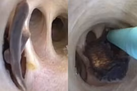 Nhiễm ký sinh trùng vì sở thích ăn cá sống và các món gỏi