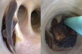 Nhiễm ký sinh trùng vì sở thích ăn cá sống và các món gỏi