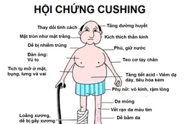 Nhiều người mắc hội chứng Cushing do lạm dụng thuốc corticoid