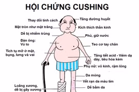 Nhiều người mắc hội chứng Cushing do lạm dụng thuốc corticoid