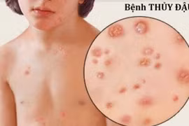 Người mắc bệnh thuỷ đậu nên ăn 3 loại thực phẩm này