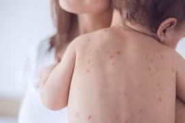 Hà Nội: Tăng cường giám sát bệnh Sởi, xử lý ổ dịch triệt để