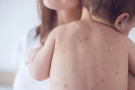 Hà Nội: Tăng cường giám sát bệnh Sởi, xử lý ổ dịch triệt để