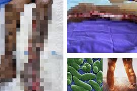 Người đàn ông 64 tuổi nguy kịch do nhiễm "vi khuẩn ăn thịt người"